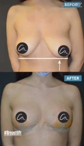 reseñas de lifting de senos