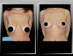 Costo de mastopexia en Turquía