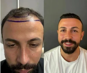 FUE стоимость