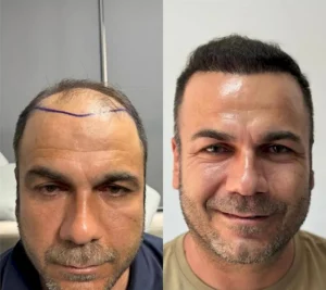 результат пересадки волос