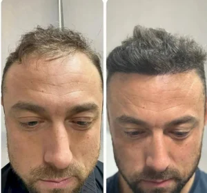 виды пересадки волос