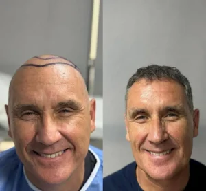 пересадка волос 2025