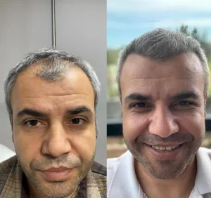 пересадка волос у мужчины