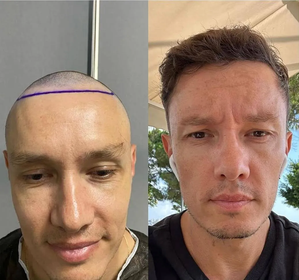 Пересадка волос в Анталии 2025: Улучшение результатов