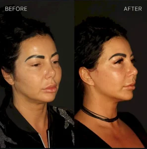 Подтяжка лица Энгин Окал