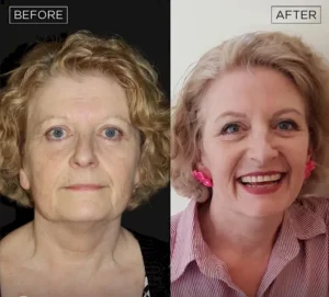 Пластическая хирургия лица Энгин Окал