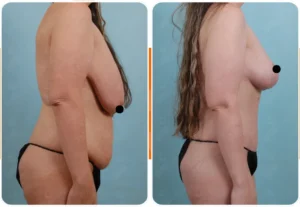 reseña de lifting de senos