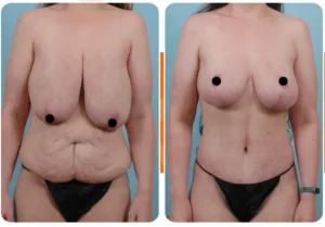 Antes y después de mastopexia