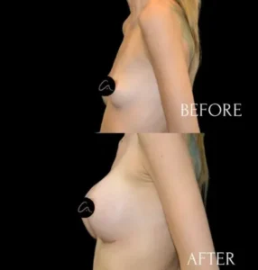 Mastopexia en Turquía