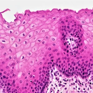 Биопсия при онкологии в Турции