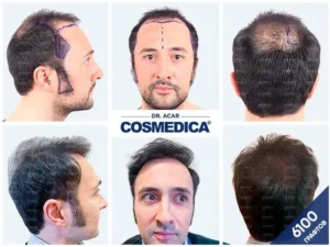 процедура пересадки волос