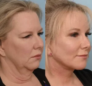 фотографии подтяжки лица в Турции