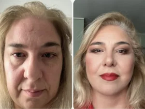 Подтяжка лица Эмре Кочман