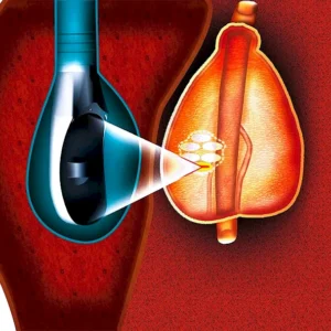 Prostate Cancer HIFU Treatment in Turkey