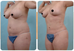 levantamiento de senos