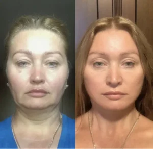 Пластическая хирургия лица, Эмре Кочман