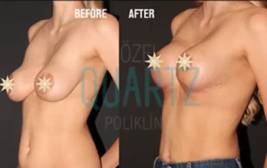 Cirugía de levantamiento de busto