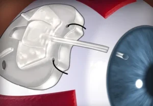 лечение глаукомы