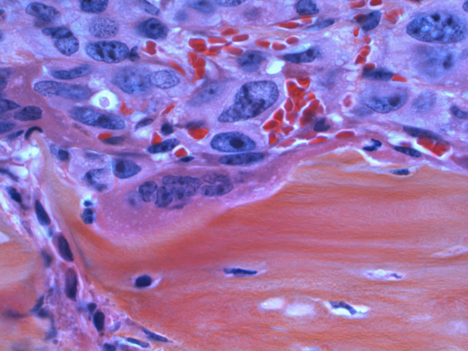Top Hospitals and Doctors for Bone Cancer Treatment in India