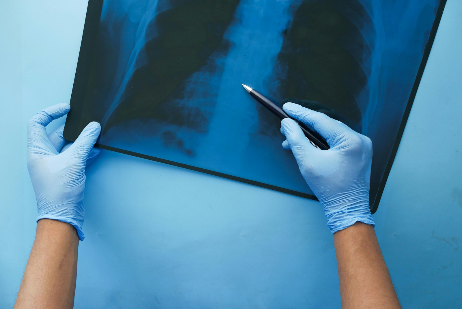 Top Hospitals and Doctors for Lung Cancer Treatment in India