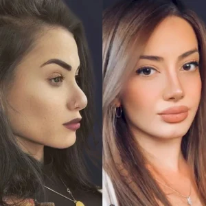 Ринопластика Серкан Барискан