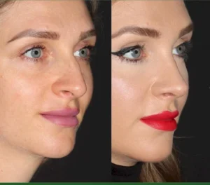 Пластика носа Энжин Окал