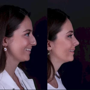 Ринопластика Энжин Окал