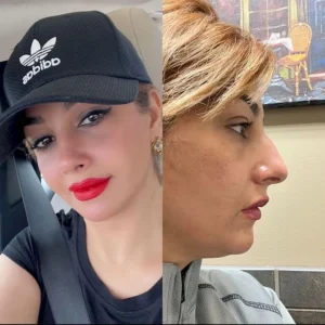 Пластика носа Акин Зенгин