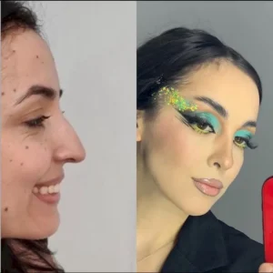 Ринопластика Акин Зенгин