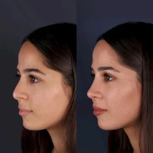 Пластика носа Абдукадир Гоксель