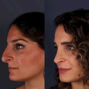 Ринопалситка Абдулкадир Гоксель