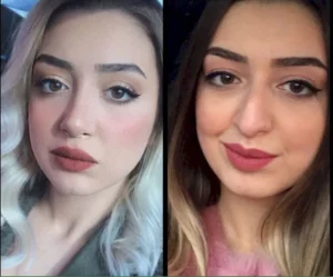 Пластика носа Серкан Барискан