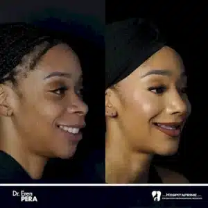 Операция на обеих челюстях (двойная)