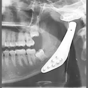 хирургия челюсти в Турции