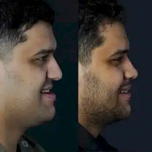 ортогнатическая хирургия в Турции