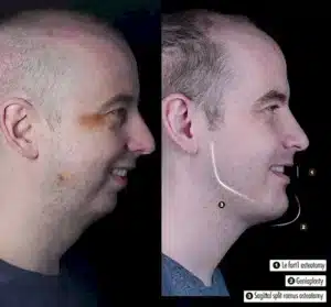 стоимость операции на челюсти в Турции