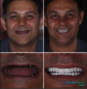 Лучшие стоматологи для All-on-6 в Анталии