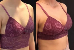 Aumento de senos en Antalya