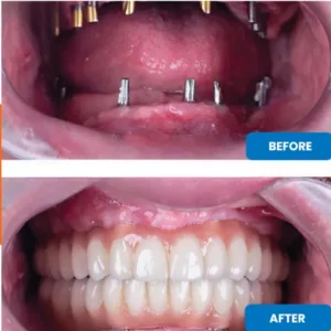 установка all-on-6 в Анталии