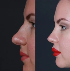 Rinoplastia Engin Erkal