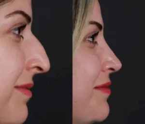 Rinoplastia en Antalya