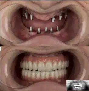 all-on-6 в Турции, Анталия