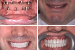 All-on-6 в Анталии