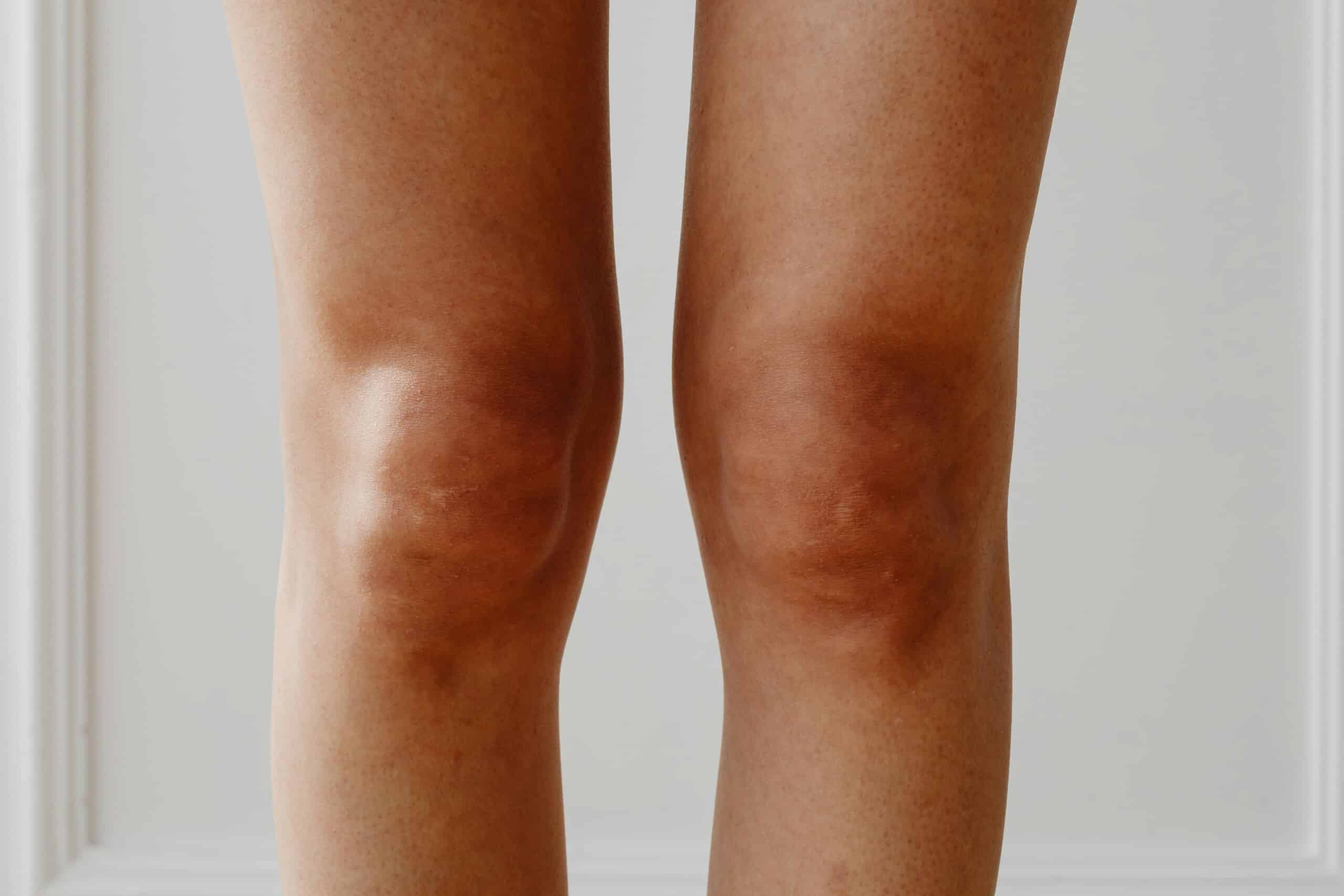 Best Knee Replacement Surgeons in Turkey – Expert Care for Your Joints
