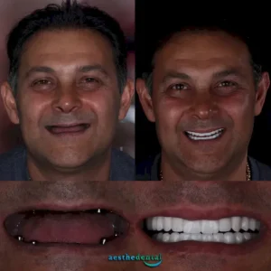 zirconium crowns in Antalya