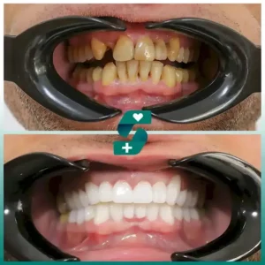 veneers in Antalya