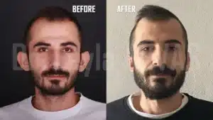 Отопластика в Турции