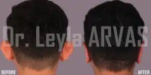 операция отопластики в Турции