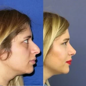 Септоринопластика в Турции Ercan Karacaoglu