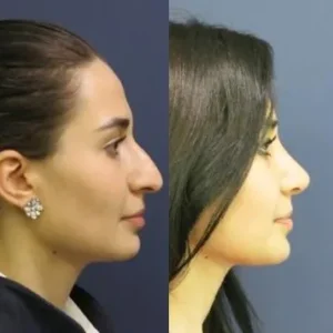 Септопластика в Турции Ercan Karacaoglu